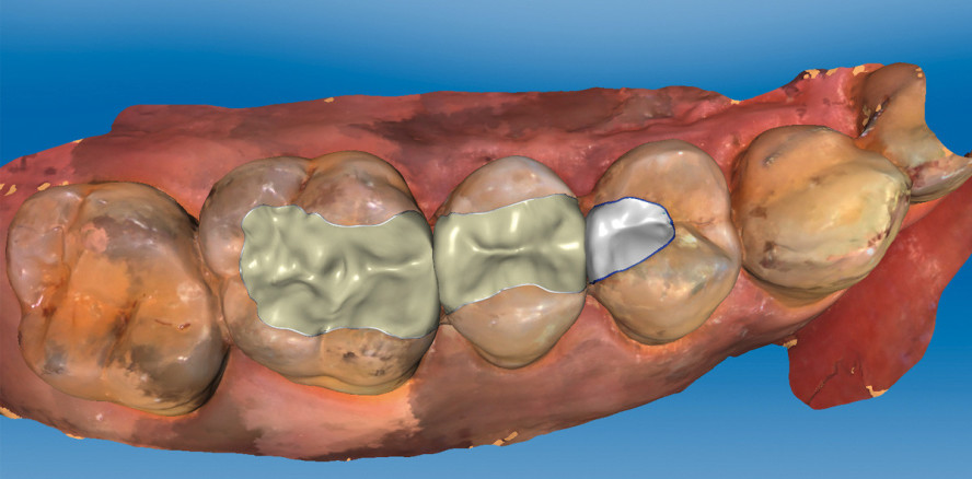 Minimalinvasive Inlay-Versorgung aus Hybridkeramik