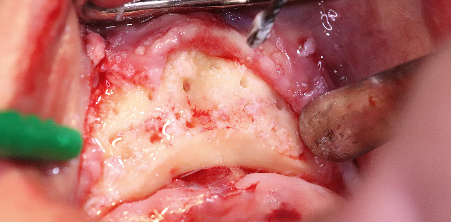 Vertikale und horizontale Kieferkammaugmentation