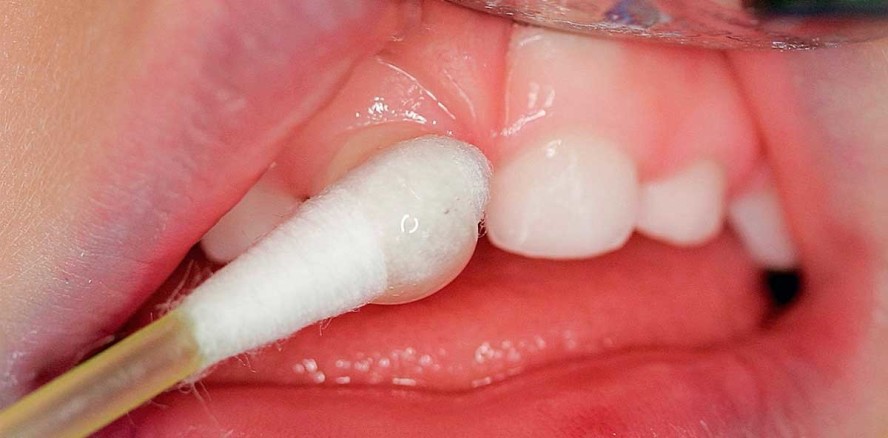 Kariesprävention bei Kindern – von Anfang an vorbeugen