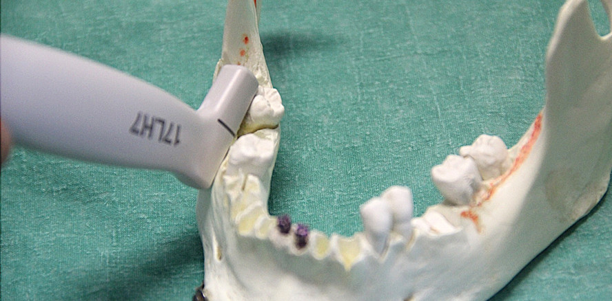 Sonografische Darstellung von verlagerten Zähnen im Unterkiefer