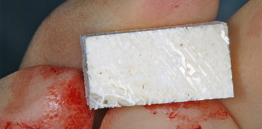 Allogene Knochenblöcke bei vertikaler und horizontaler Augmentation