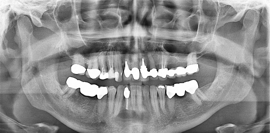 Knochentumor in der rechten Unterkieferfront