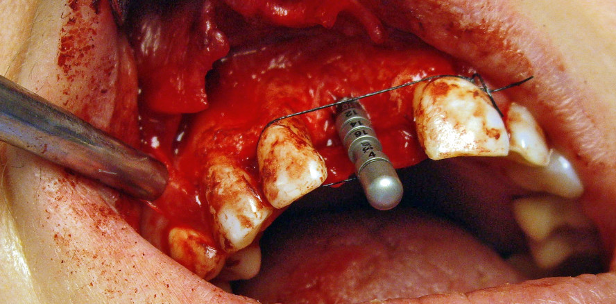 Komplexe Versorgung einer Einzelzahnlücke