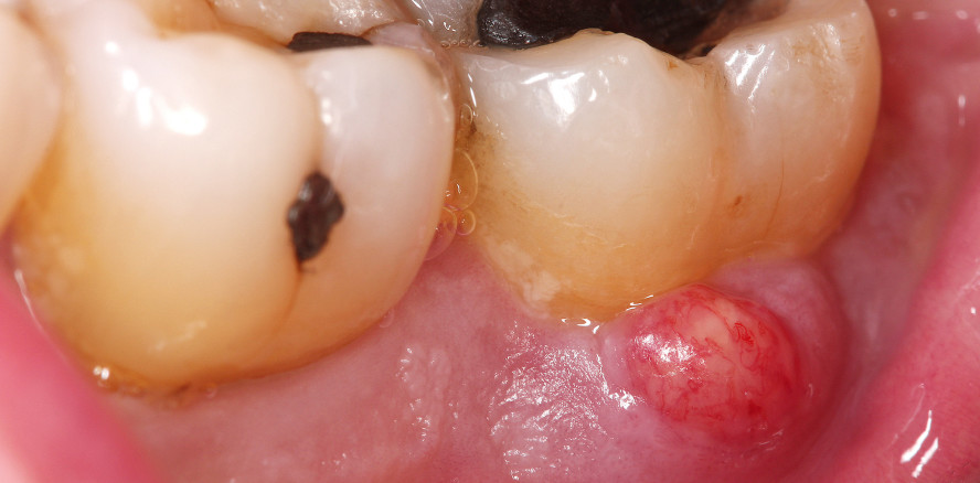 Komplikationen während und nach der zahnärztlichen Prophylaxe