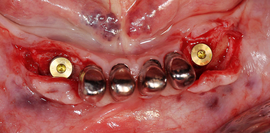 Der kompromittierte Patient – Ein minimalinvasives Konzept