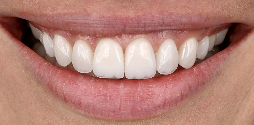 Ästhetische Parodontalchirurgie: Minimalinvasive  Kronenverlängerung mit Schall