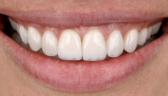 Ästhetische Parodontalchirurgie: Minimalinvasive  Kronenverlängerung mit Schall