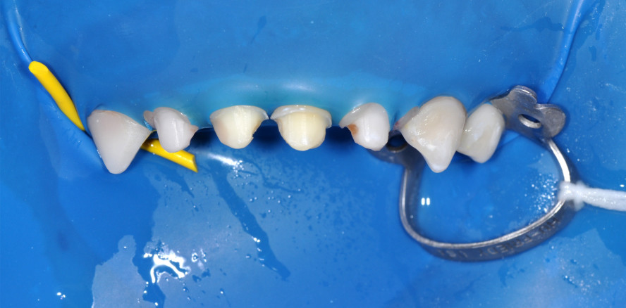 Kronenversorgung pädiatrischer Zähne