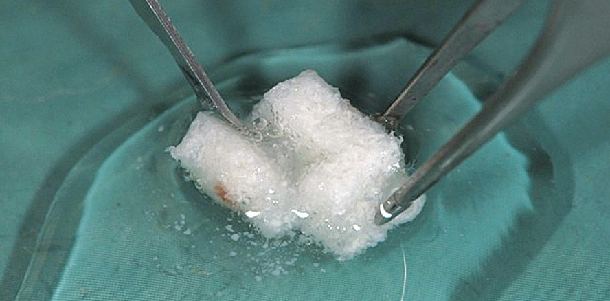 L-shaped Konturenaugmentation im Frontzahnbereich