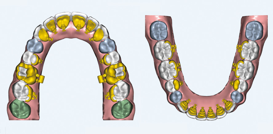 Lingualtechnik mit virtueller Planung und individueller Apparatur