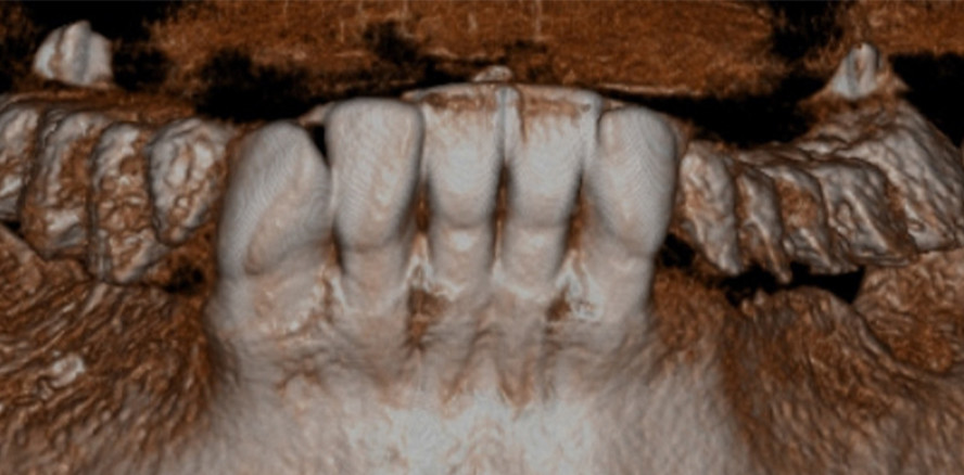 Sicherstellung einer ausreichenden gingivalen Breite um Implantate