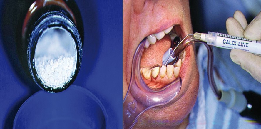 Medikamentöse Einlagen bei der Endo