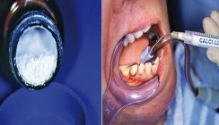 Medikamentöse Einlagen bei der Endo