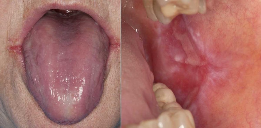 „Menopause im Mund – Gibt es das überhaupt?“