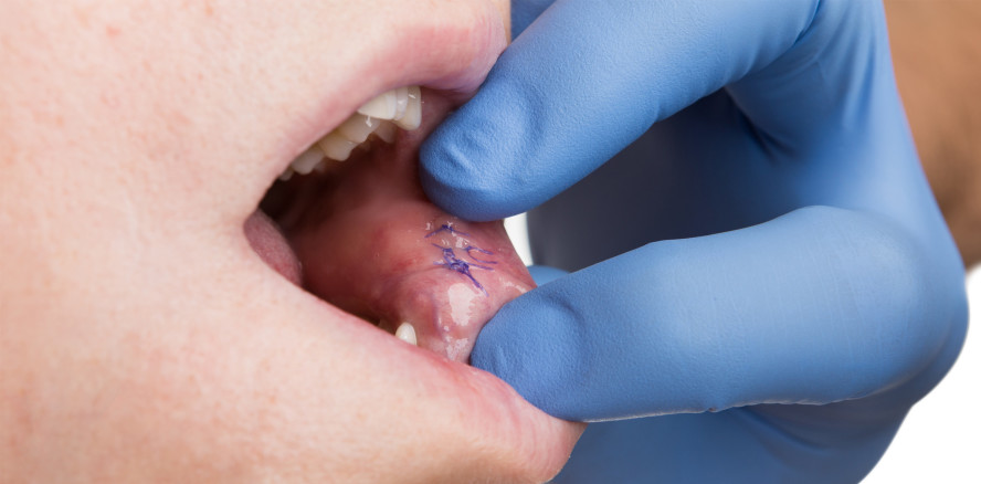 Implantatverluste im bestrahlten Kiefer