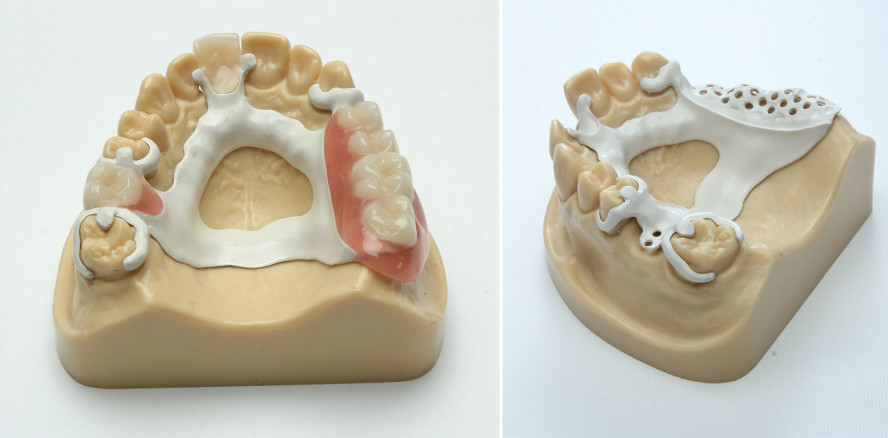 Metallfreier Klammermodelguss: Frästechnik durch PEEK