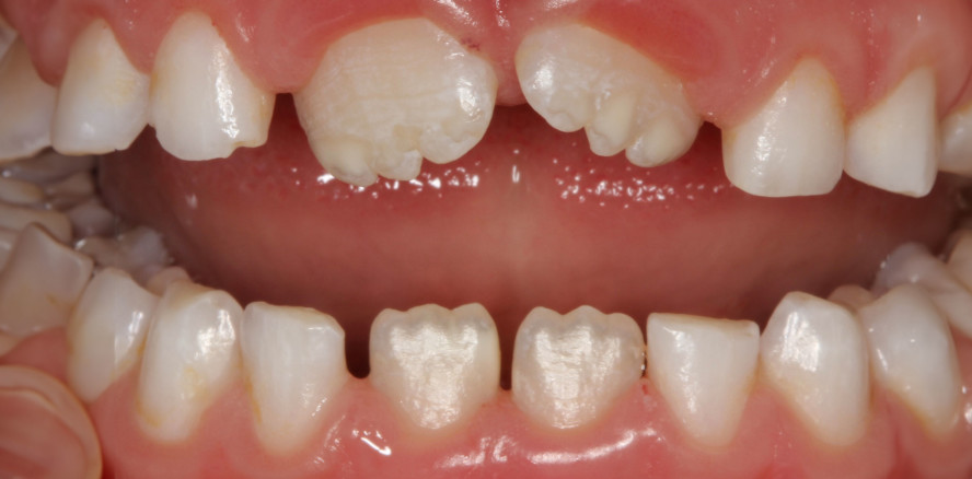 Molaren-Inzisiven-­ Hypomineralisation im Fokus