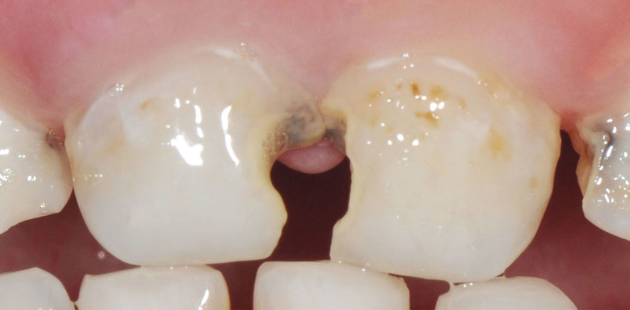 Ein konservativer Ansatz für die Restauration von Kinderzähnen