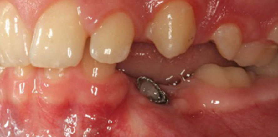 Multiple Aplasie von Zähnen – ein Therapiekonzept