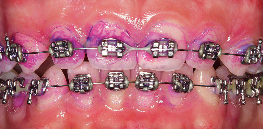 Professionelle Mundhygiene bei Multibandapparaturen