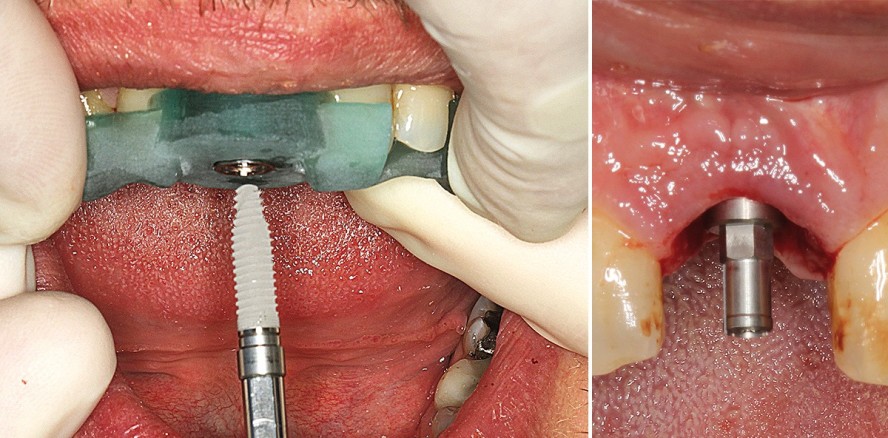 Navigierte Sofortimplantation und provisorische Sofortversorgung