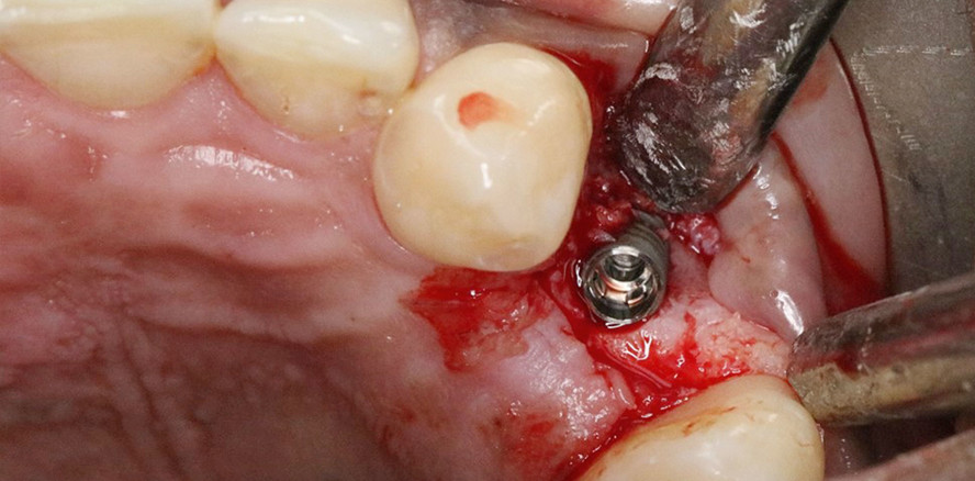 Zweizeitige Implantattherapie bei Einzelzahnversorgung