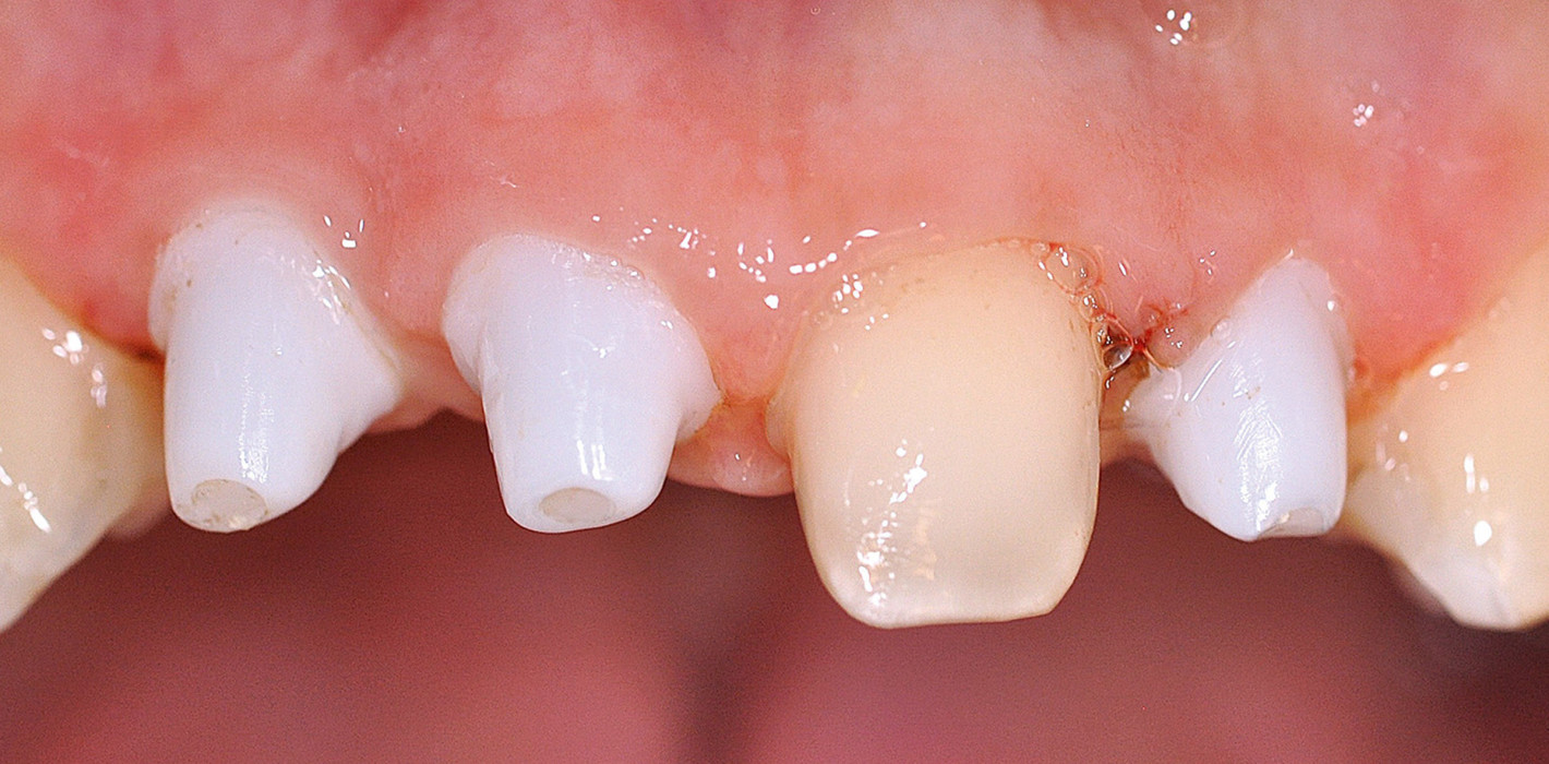 Biologische Zahnmedizin und Keramikimplantate
