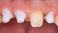 Biologische Zahnmedizin und Keramikimplantate