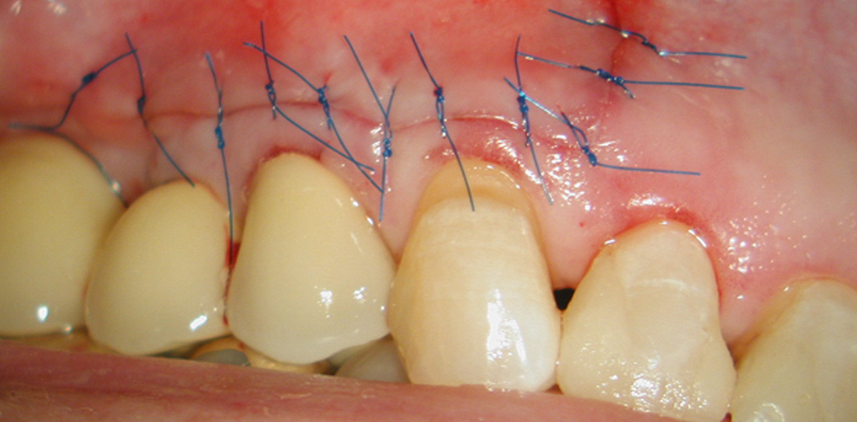 Weichgewebemanagement in der endodontischen Mikrochirurgie