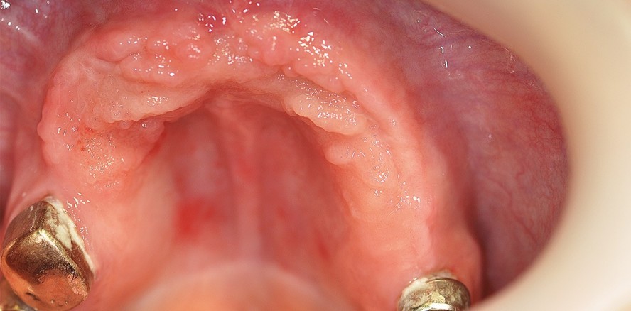 Implantatgetragener Zahnersatz im kompromittierten Oberkiefer