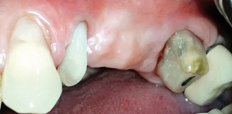 Multidisziplinärer Erhalt eines Zahns als temporärer Brückenpfeiler