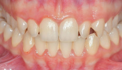 Okklusionsqualität von erwachsenen Patienten mit posteriorem Kreuzbiss