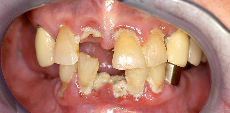 Prävention oraler Leiden bei schweren Allgemeinerkrankungen