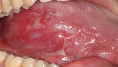 Oraler Lichen planus