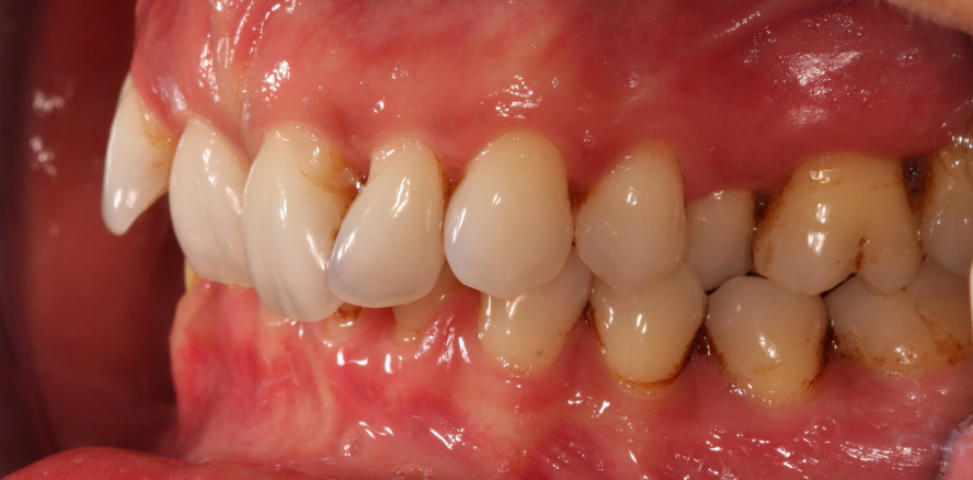 Kombiniert parodontologisch-kieferorthopädische Behandlung