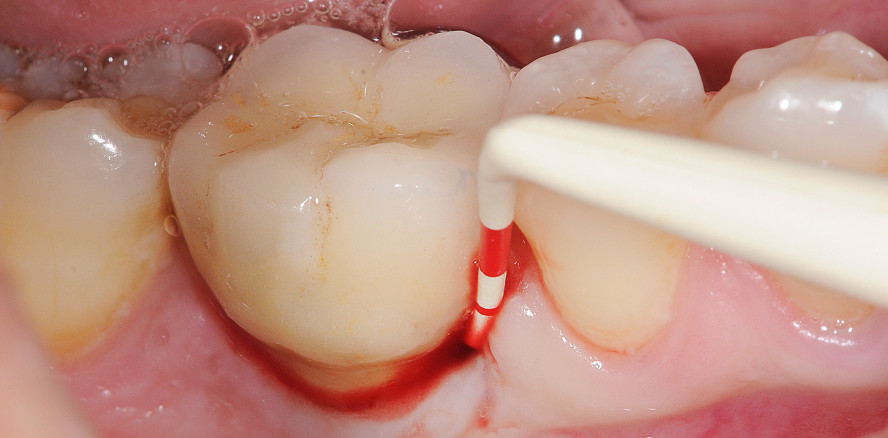 Behandlung von parodontalen und periimplären Infektionen