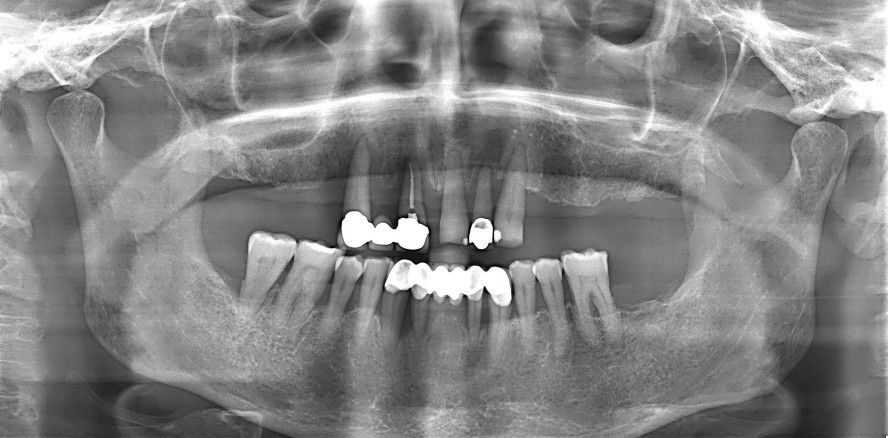 Parodontitistherapie und implantatprothetische Rekonstruktion