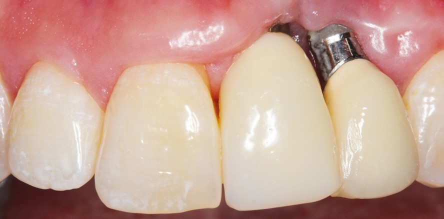 Periimplantitis erfolgreich behandeln – geht das?