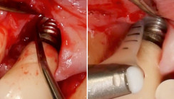 Resektive Periimplantitistherapie – Indikation und Herausforderungen