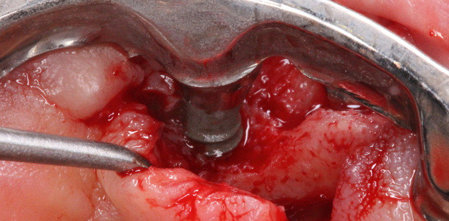 Regenerative Behandlung eines Periimplantitisdefekts