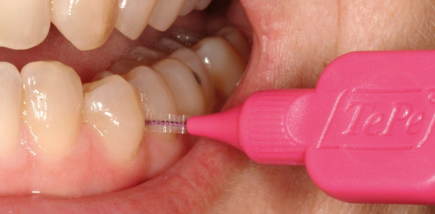 Die richtige Anwendung von Interdentalbürsten