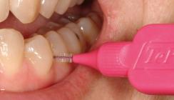 Die richtige Anwendung von Interdentalbürsten