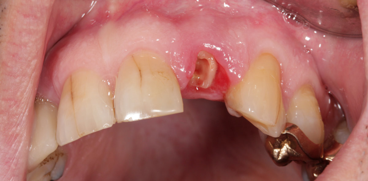 Postendodontische Versorgungen im Fokus