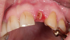 Postendodontische Versorgungen im Fokus