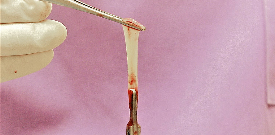 Perforation der Schneider’schen Membran