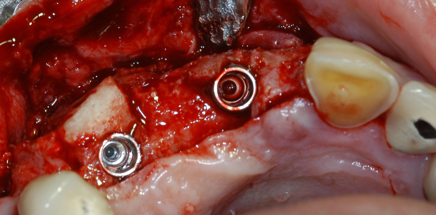 Primäre Implantatstabilität – ist mehr immer besser?