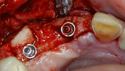 Primäre Implantatstabilität – ist mehr immer besser?
