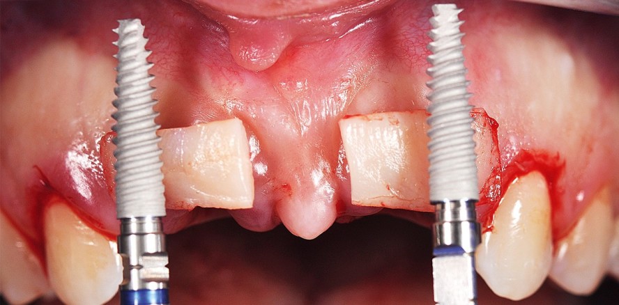 Prothetisch geführte Chirurgie im Frontzahnbereich