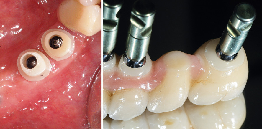 Prothetische Versorgung mit Implantaten