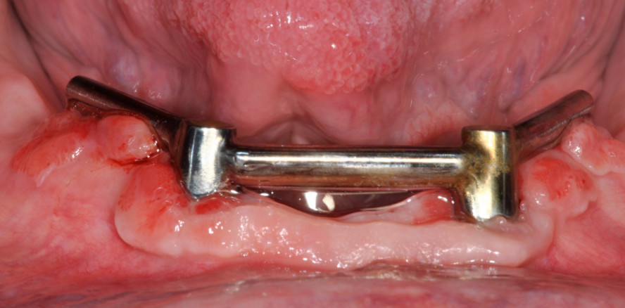 Komplikationen bei abnehmbarer Implantatprothetik